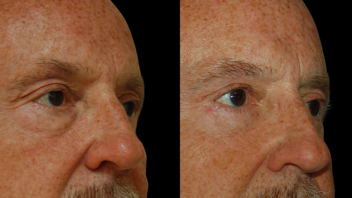 Upper & Lower Eyelid Surgery Before & After Gallery - Patient 330420 - Image 5
