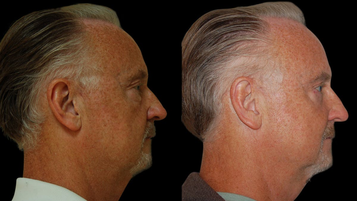 Upper & Lower Eyelid Surgery Before & After Gallery - Patient 330420 - Image 6