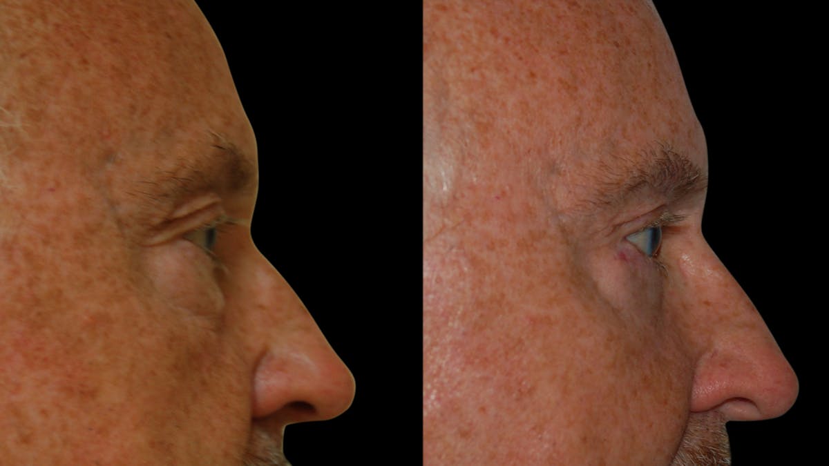 Upper & Lower Eyelid Surgery Before & After Gallery - Patient 330420 - Image 7