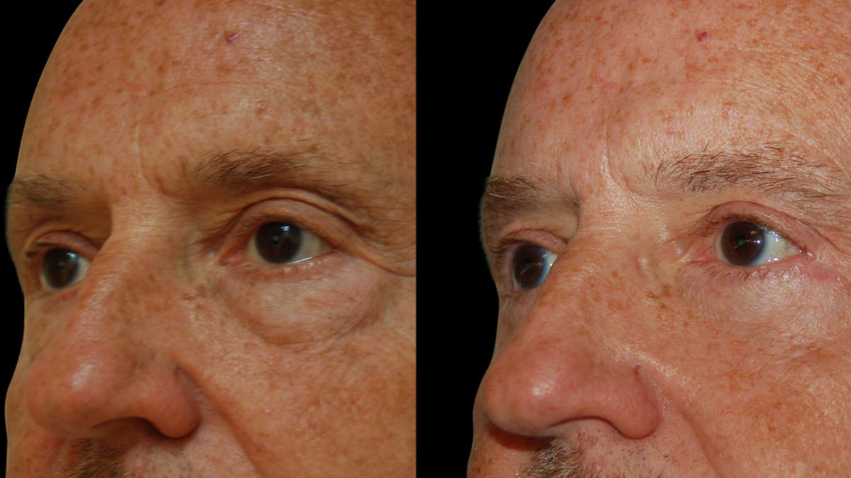Upper & Lower Eyelid Surgery Before & After Gallery - Patient 330420 - Image 8