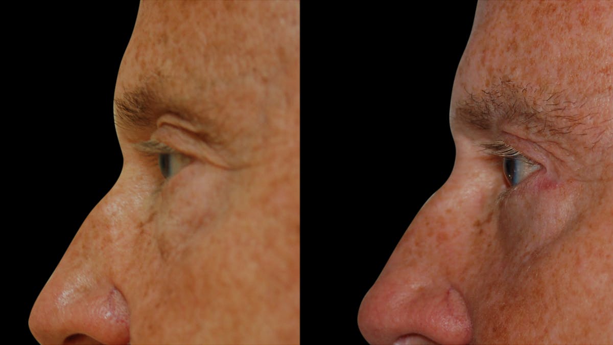 Upper & Lower Eyelid Surgery Before & After Gallery - Patient 330420 - Image 9