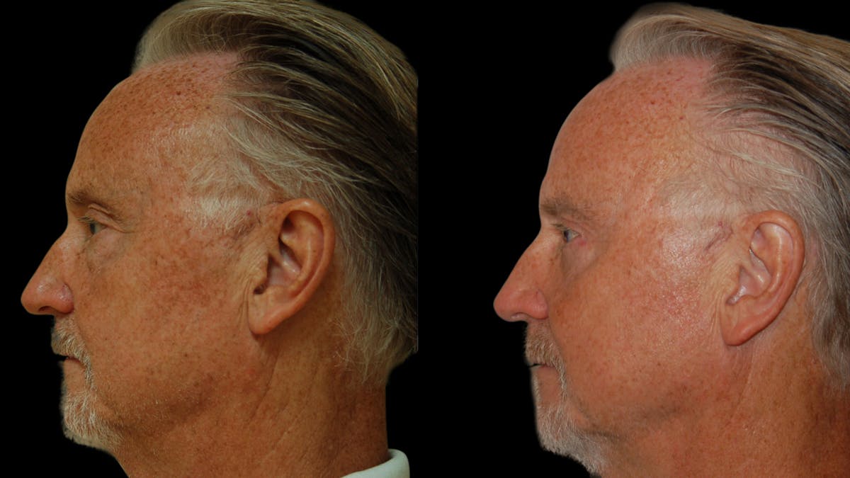 Upper & Lower Eyelid Surgery Before & After Gallery - Patient 330420 - Image 10