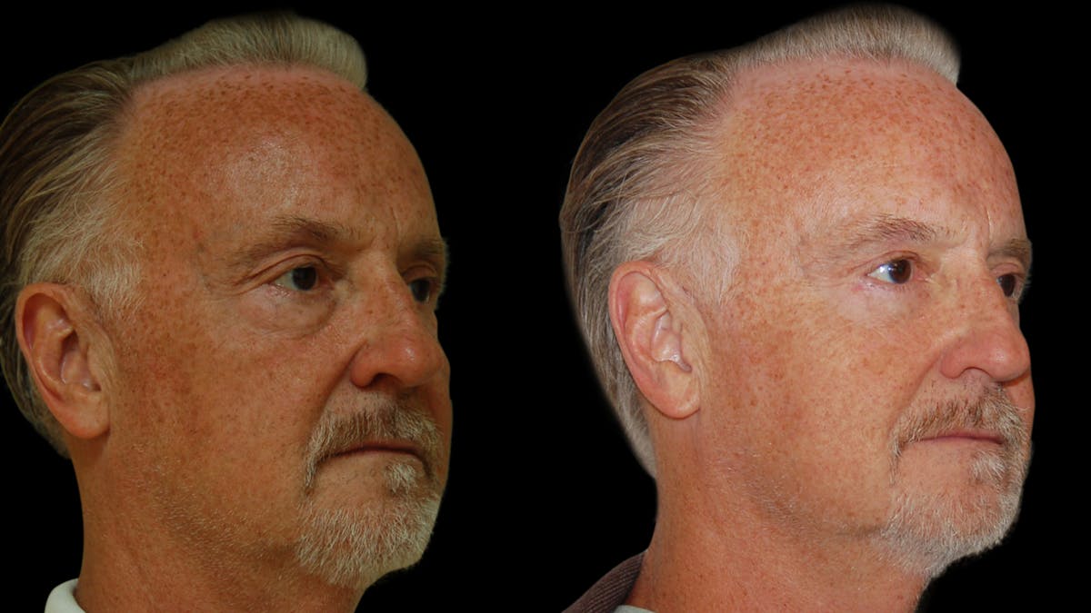 Upper & Lower Eyelid Surgery Before & After Gallery - Patient 330420 - Image 11