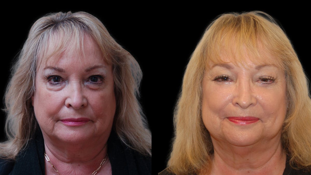Upper & Lower Eyelid Surgery Before & After Gallery - Patient 349848 - Image 1
