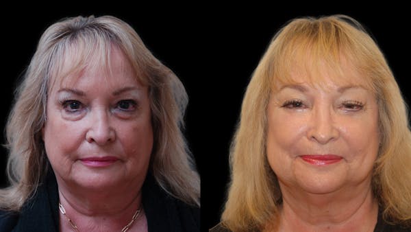 Upper & Lower Eyelid Surgery Before & After Gallery - Patient 349848 - Image 1