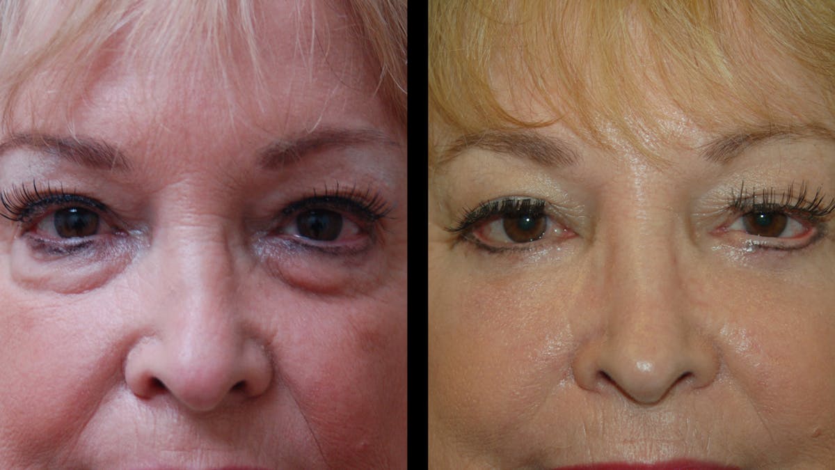 Upper & Lower Eyelid Surgery Before & After Gallery - Patient 349848 - Image 2