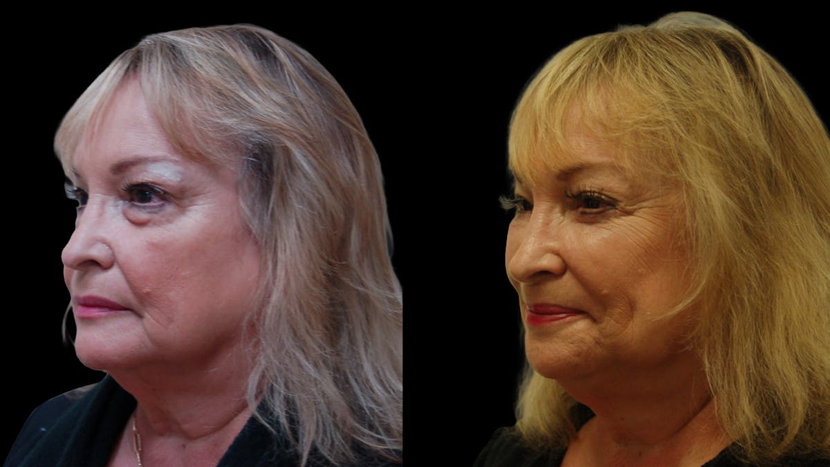 Upper & Lower Eyelid Surgery Before & After Gallery - Patient 349848 - Image 3