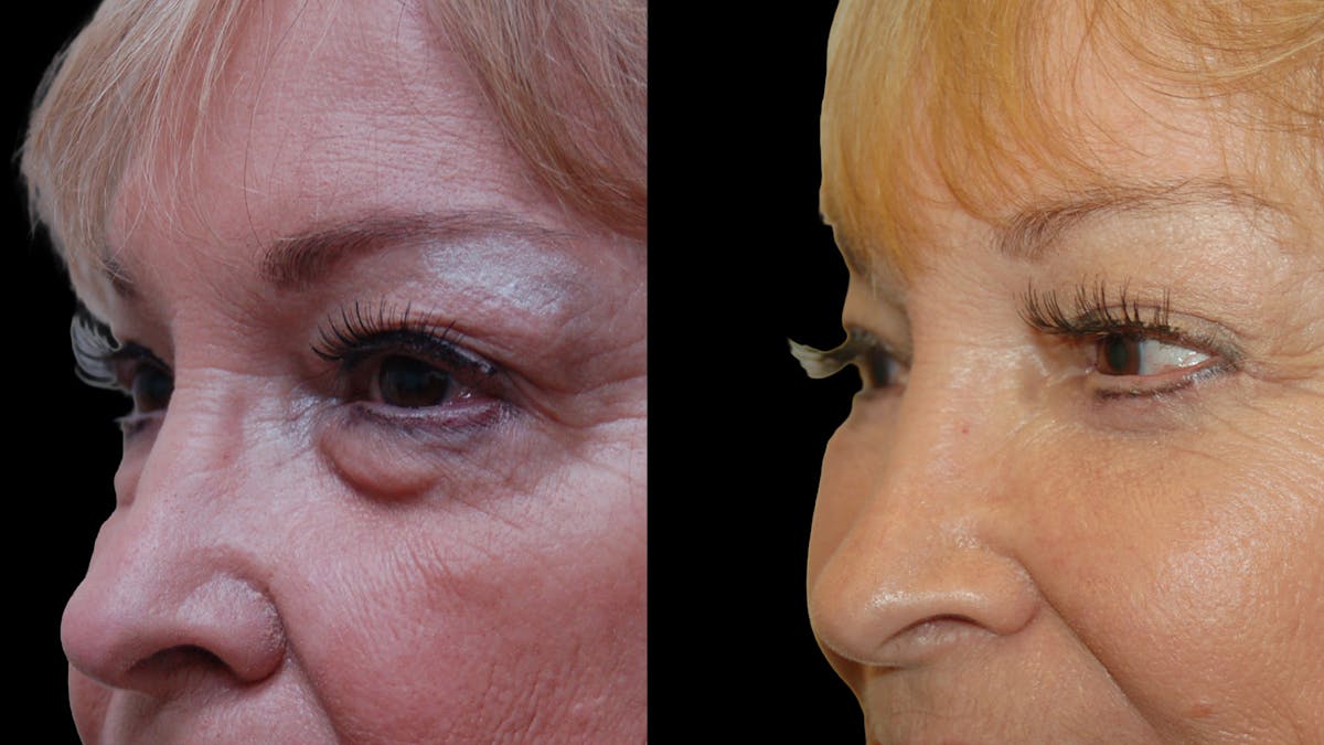 Upper & Lower Eyelid Surgery Before & After Gallery - Patient 349848 - Image 4