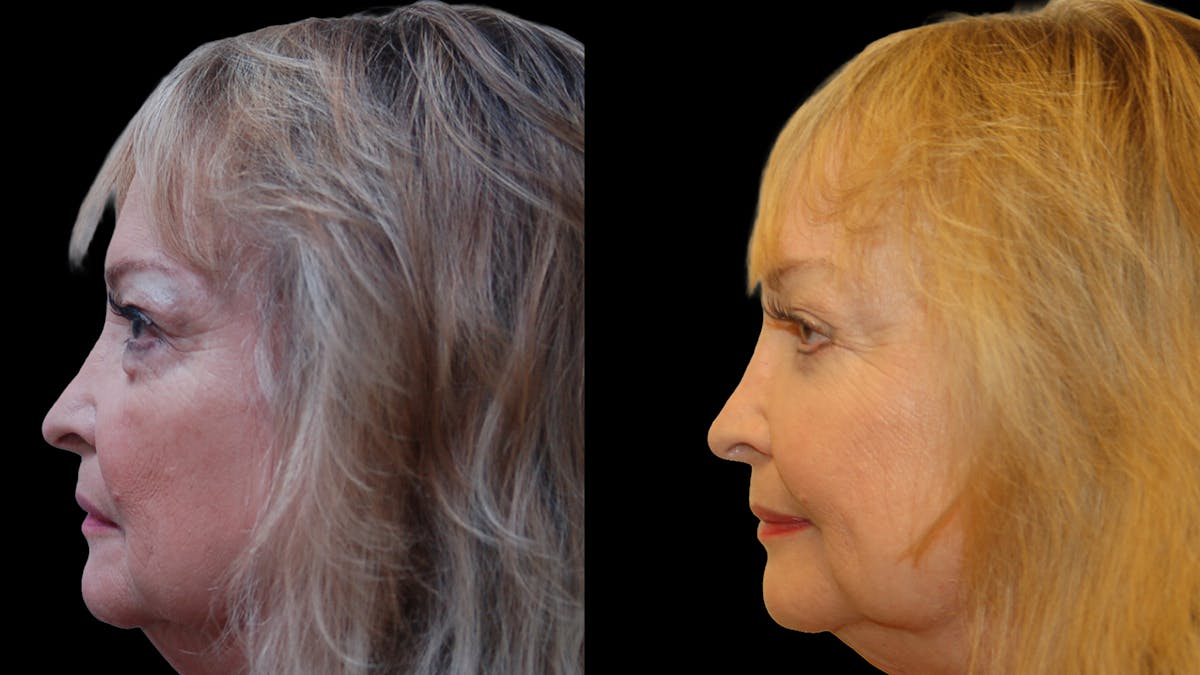Upper & Lower Eyelid Surgery Before & After Gallery - Patient 349848 - Image 5