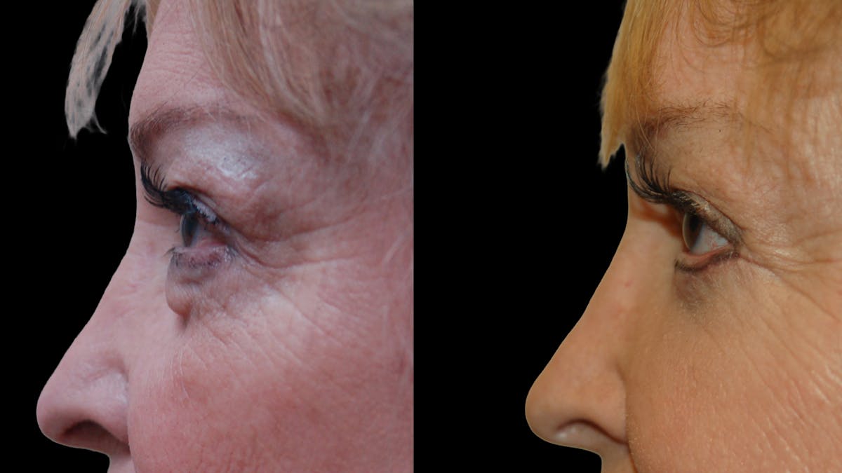 Upper & Lower Eyelid Surgery Before & After Gallery - Patient 349848 - Image 6