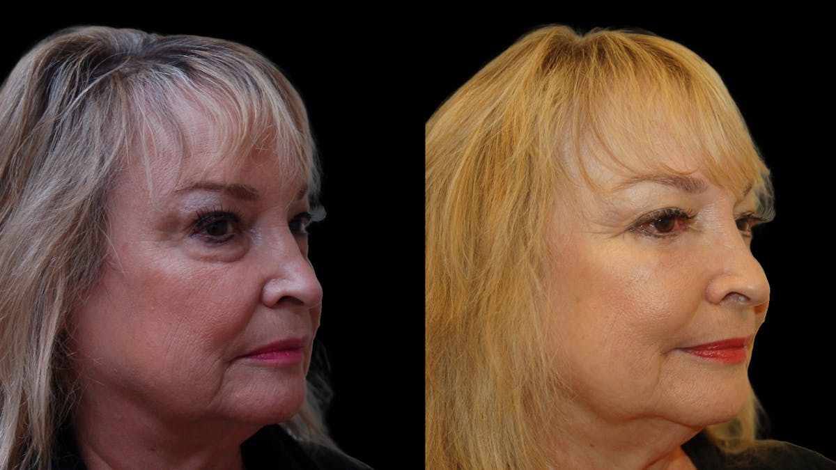 Upper & Lower Eyelid Surgery Before & After Gallery - Patient 349848 - Image 7