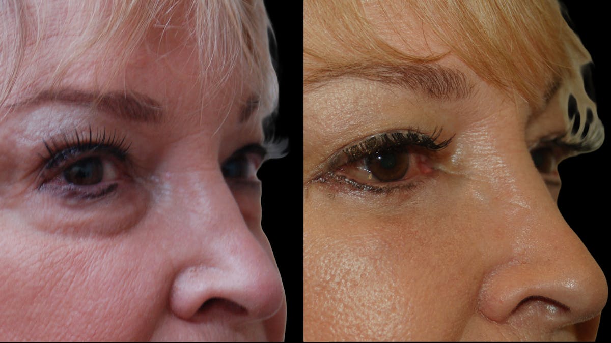 Upper & Lower Eyelid Surgery Before & After Gallery - Patient 349848 - Image 9