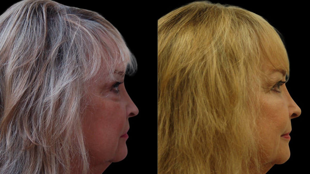 Upper & Lower Eyelid Surgery Before & After Gallery - Patient 349848 - Image 10