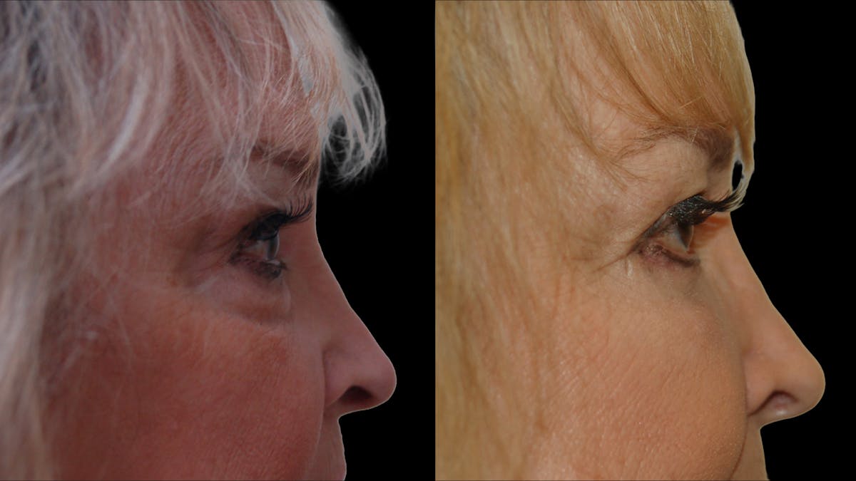 Upper & Lower Eyelid Surgery Before & After Gallery - Patient 349848 - Image 11
