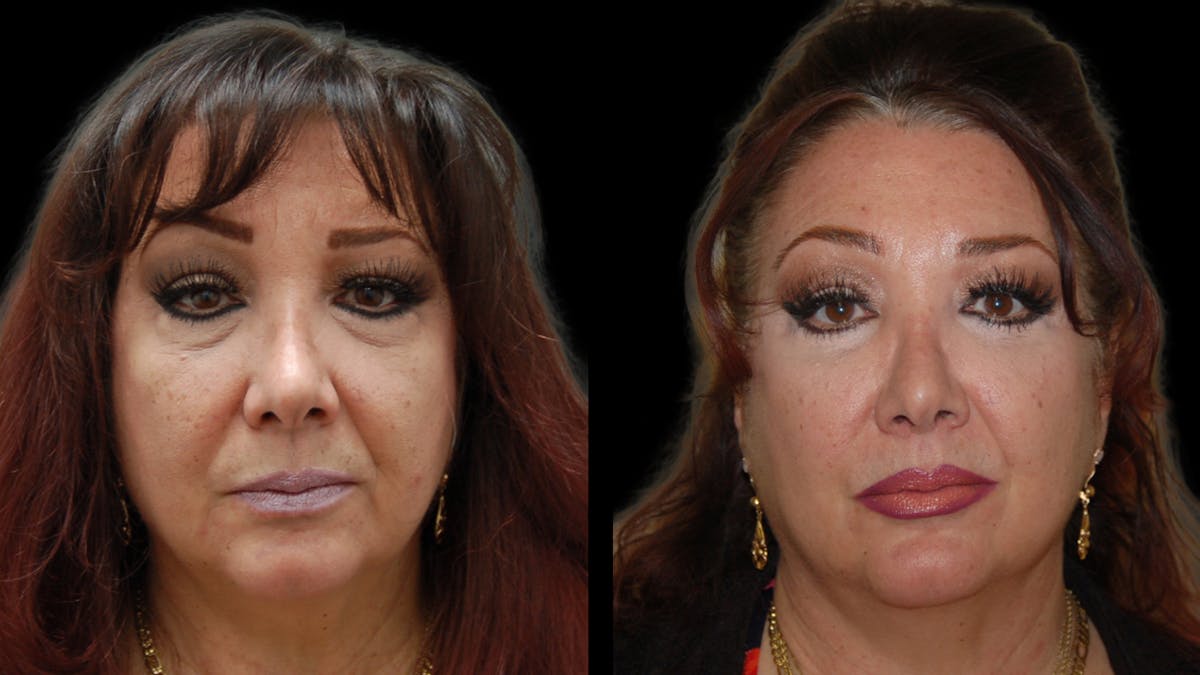 Upper & Lower Eyelid Surgery Before & After Gallery - Patient 396802 - Image 1