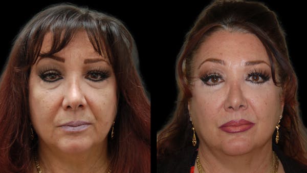 Upper & Lower Eyelid Surgery Before & After Gallery - Patient 396802 - Image 1