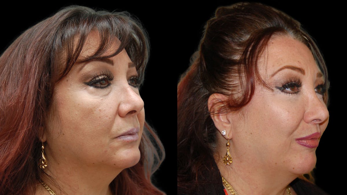 Upper & Lower Eyelid Surgery Before & After Gallery - Patient 396802 - Image 3