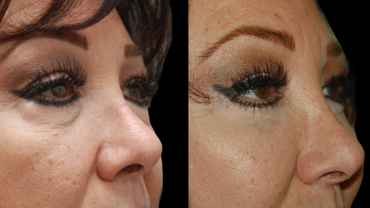 Upper & Lower Eyelid Surgery Before & After Gallery - Patient 396802 - Image 4