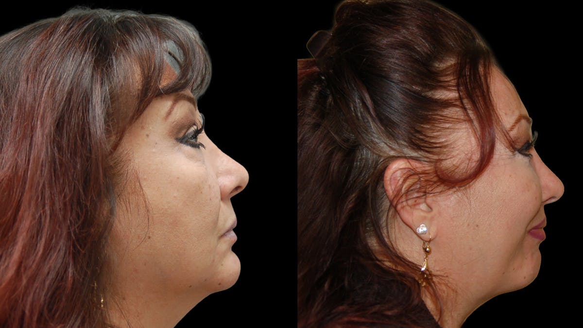 Upper & Lower Eyelid Surgery Before & After Gallery - Patient 396802 - Image 5