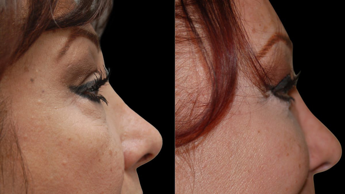 Upper & Lower Eyelid Surgery Before & After Gallery - Patient 396802 - Image 6