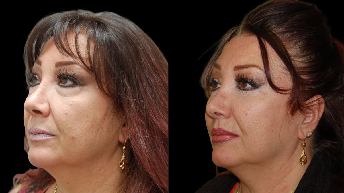 Upper & Lower Eyelid Surgery Before & After Gallery - Patient 396802 - Image 7
