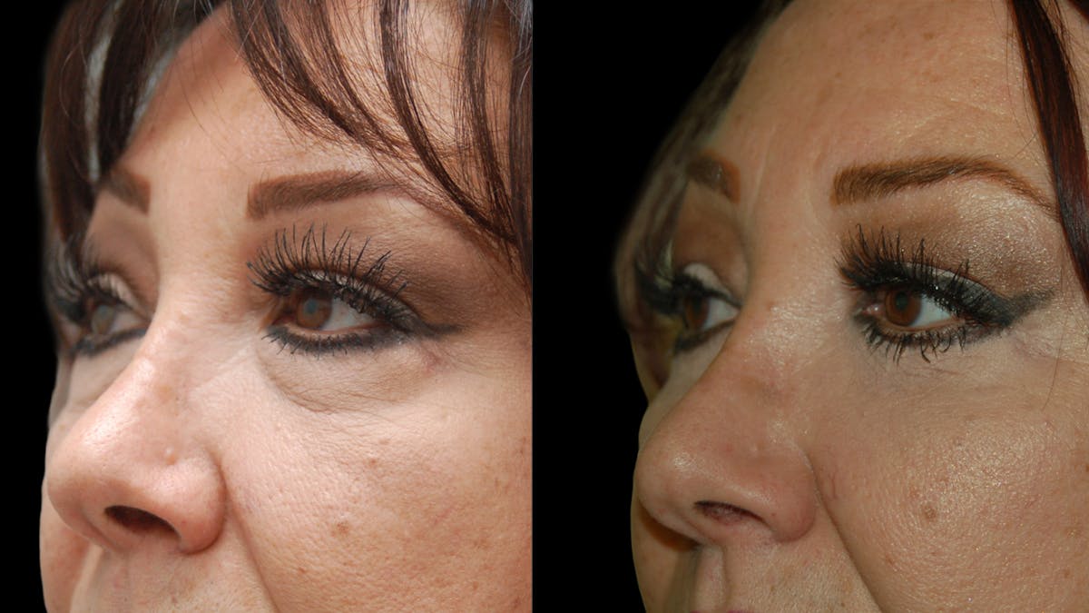 Upper & Lower Eyelid Surgery Before & After Gallery - Patient 396802 - Image 8
