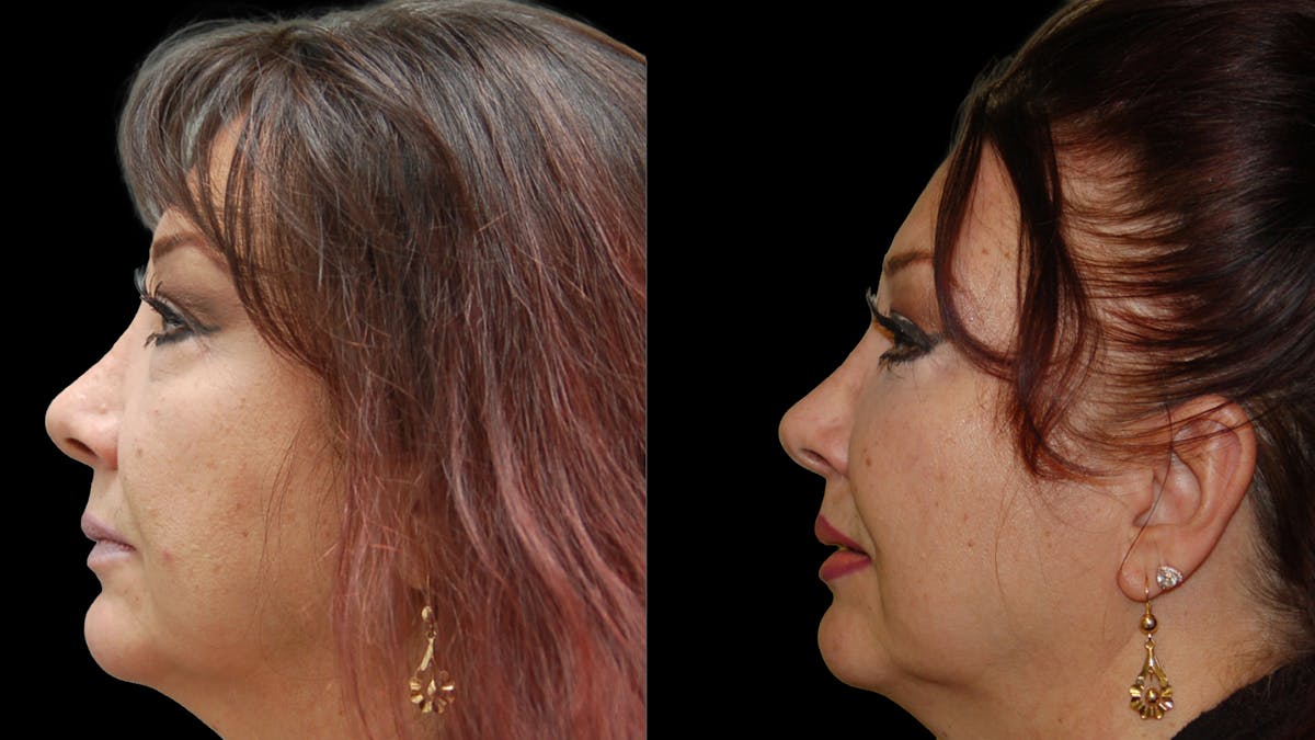 Upper & Lower Eyelid Surgery Before & After Gallery - Patient 396802 - Image 9