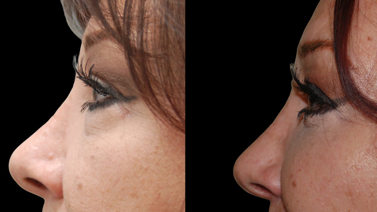 Upper & Lower Eyelid Surgery Before & After Gallery - Patient 396802 - Image 10