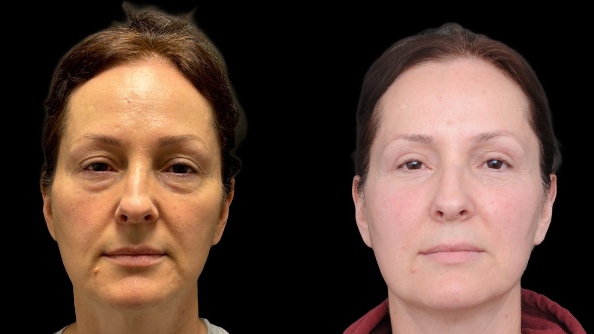 Upper & Lower Eyelid Surgery Before & After Gallery - Patient 325065 - Image 1