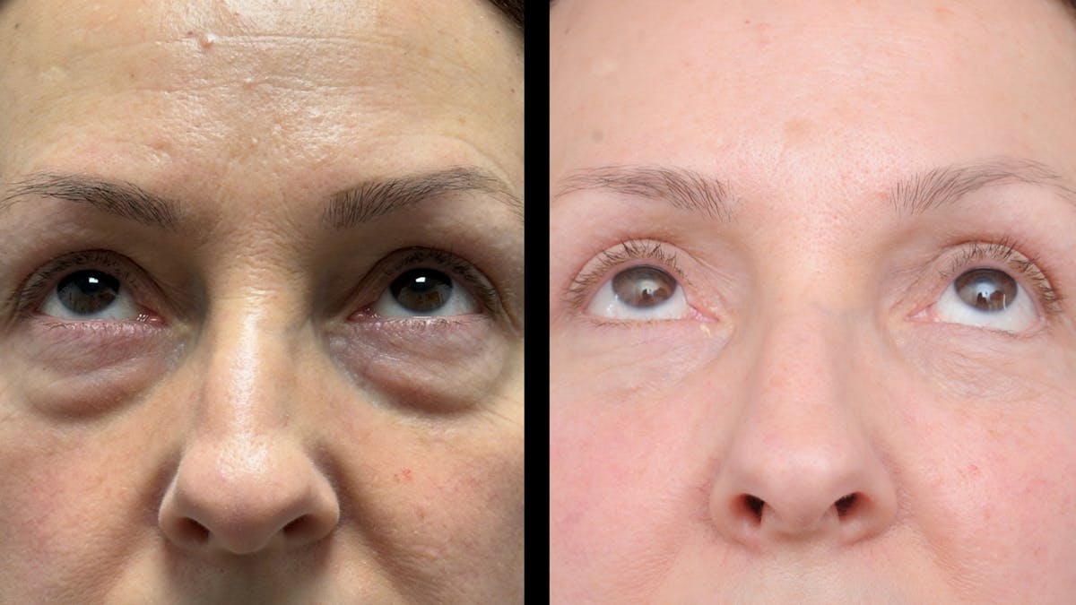 Upper & Lower Eyelid Surgery Before & After Gallery - Patient 325065 - Image 2