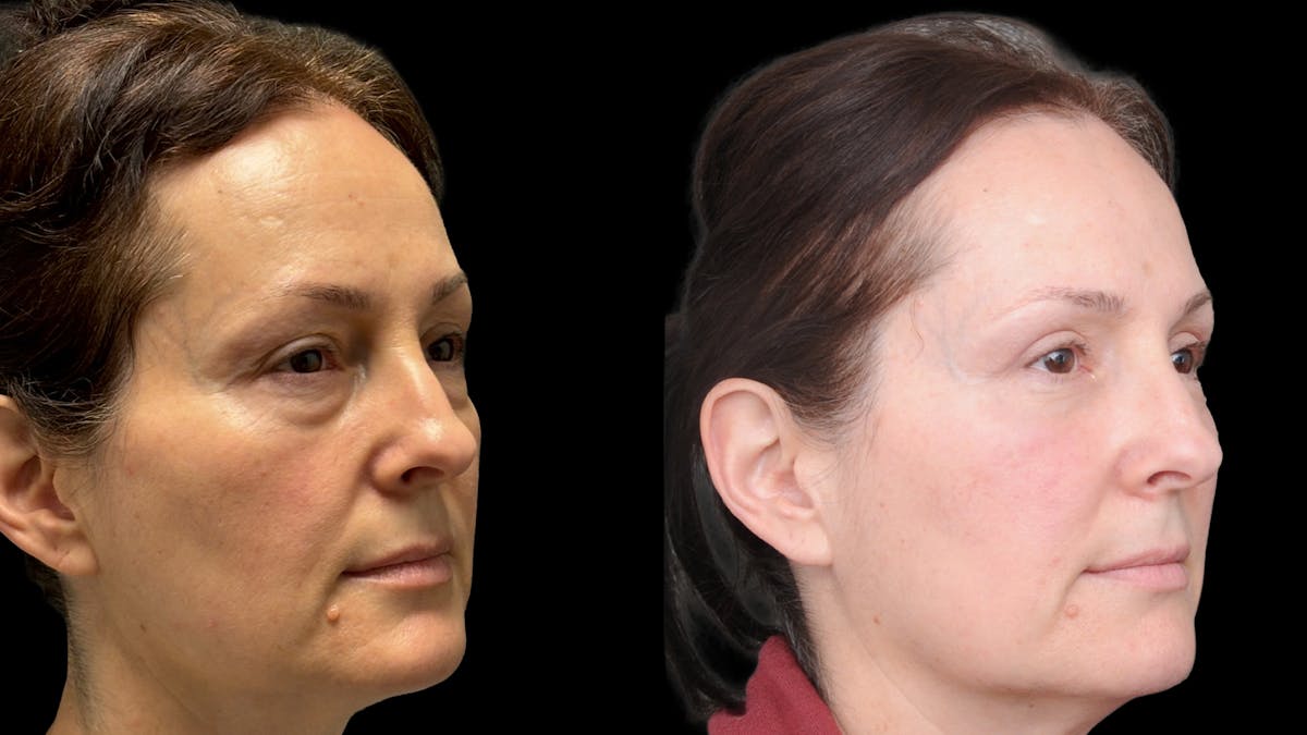 Upper & Lower Eyelid Surgery Before & After Gallery - Patient 325065 - Image 3