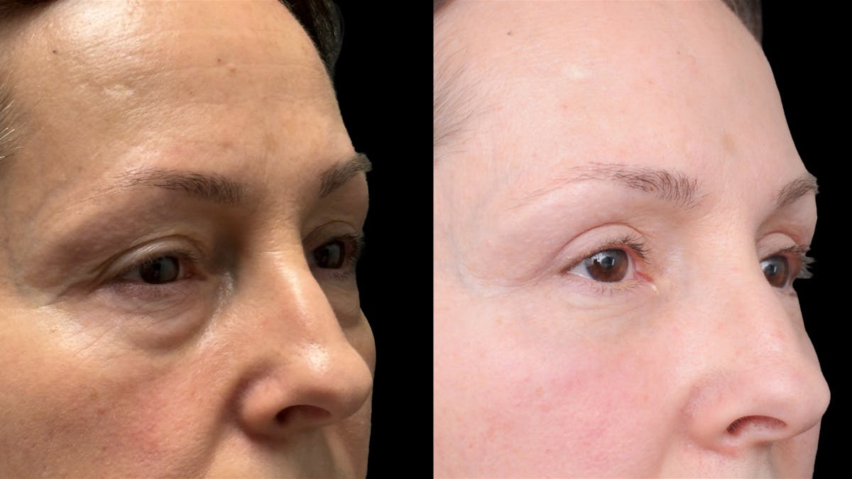 Upper & Lower Eyelid Surgery Before & After Gallery - Patient 325065 - Image 4