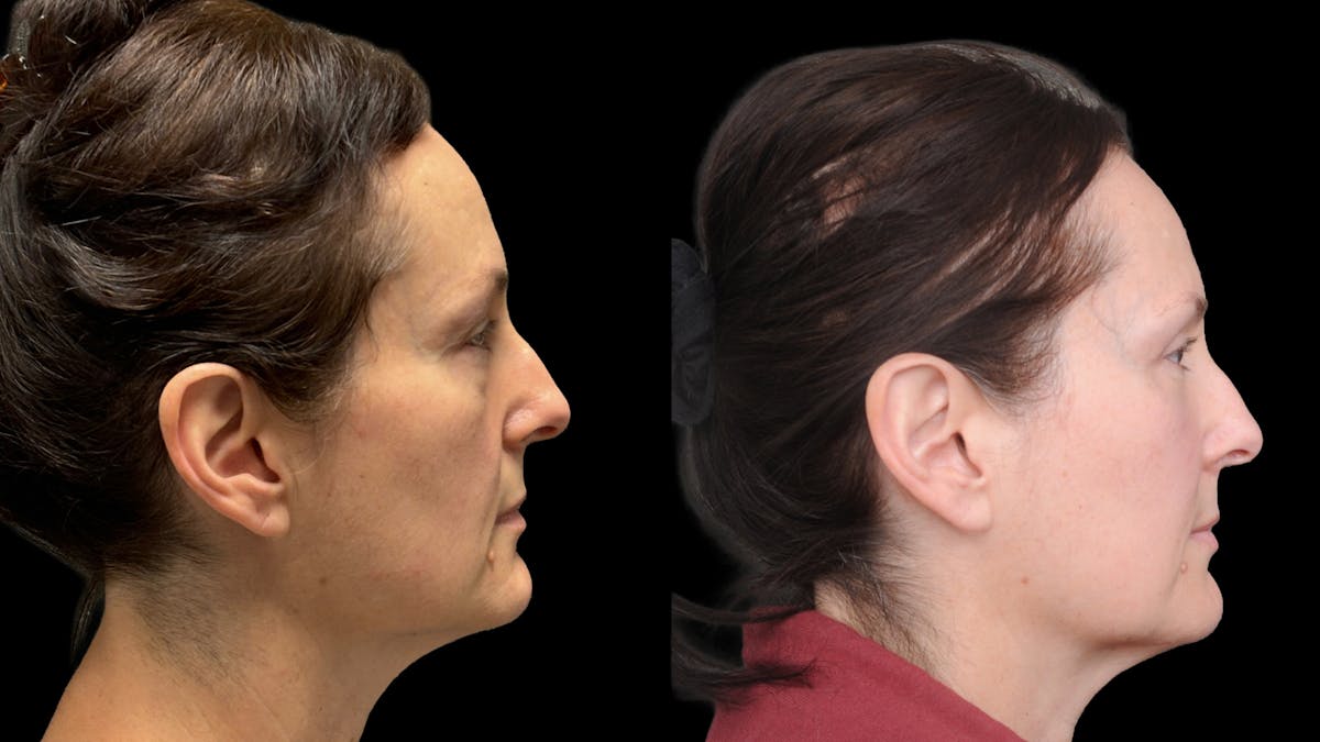 Upper & Lower Eyelid Surgery Before & After Gallery - Patient 325065 - Image 5