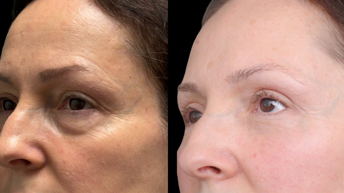 Upper & Lower Eyelid Surgery Before & After Gallery - Patient 325065 - Image 8
