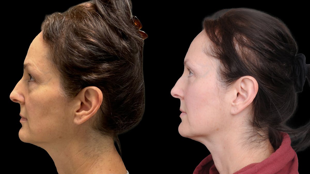 Upper & Lower Eyelid Surgery Before & After Gallery - Patient 325065 - Image 9