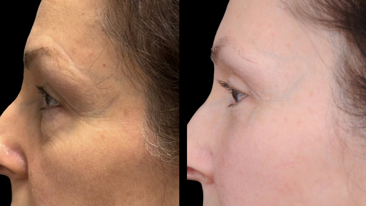 Upper & Lower Eyelid Surgery Before & After Gallery - Patient 325065 - Image 10