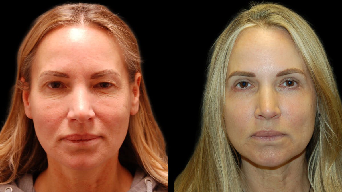 Upper & Lower Eyelid Surgery Before & After Gallery - Patient 154708 - Image 1