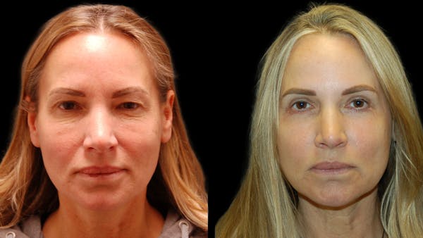 Upper & Lower Eyelid Surgery Before & After Gallery - Patient 154708 - Image 1