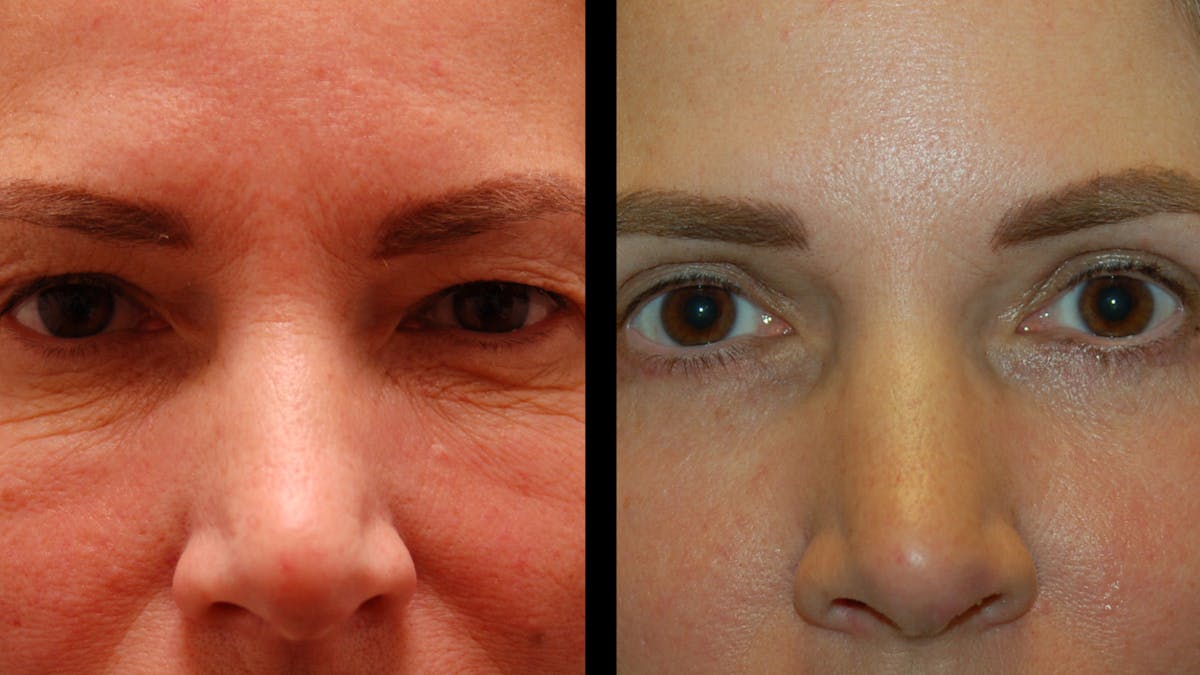 Upper & Lower Eyelid Surgery Before & After Gallery - Patient 154708 - Image 2