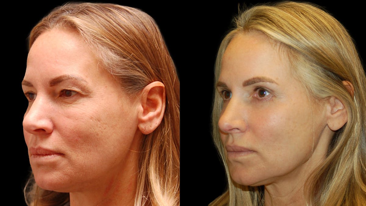 Upper & Lower Eyelid Surgery Before & After Gallery - Patient 154708 - Image 3