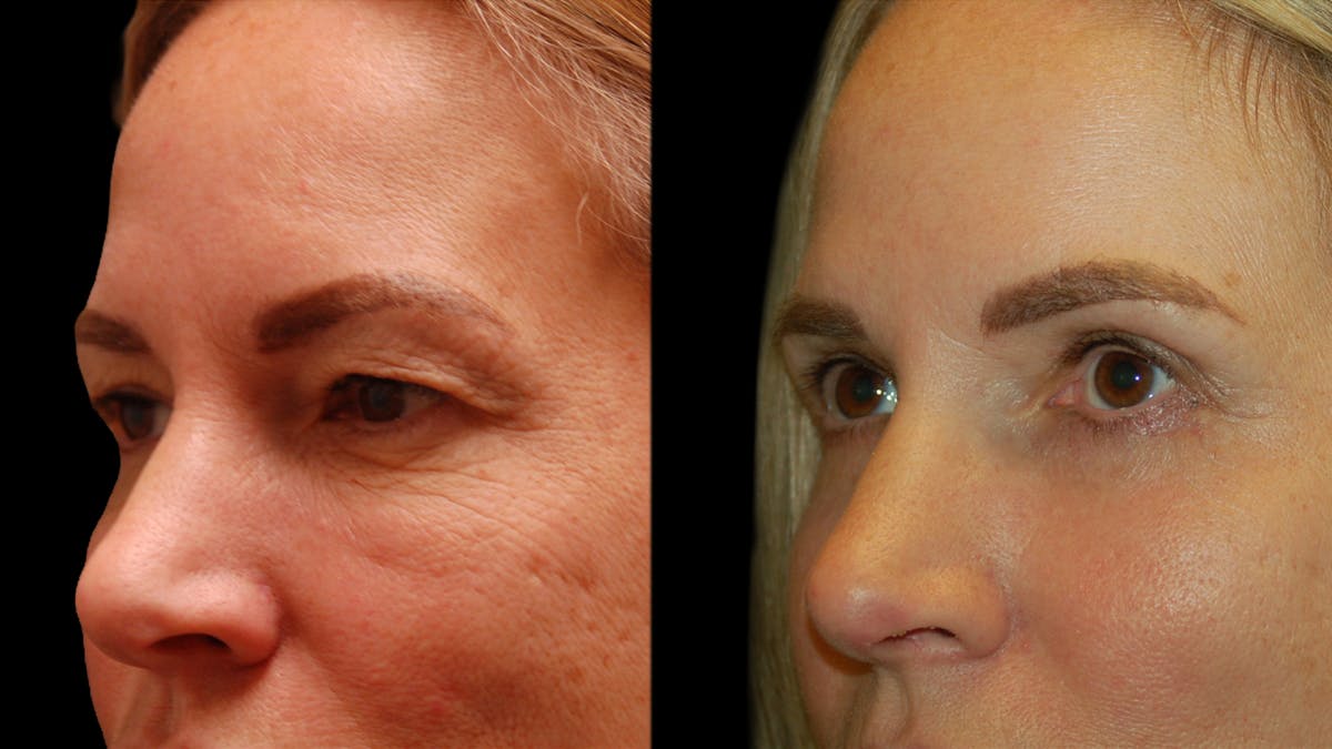Upper & Lower Eyelid Surgery Before & After Gallery - Patient 154708 - Image 4
