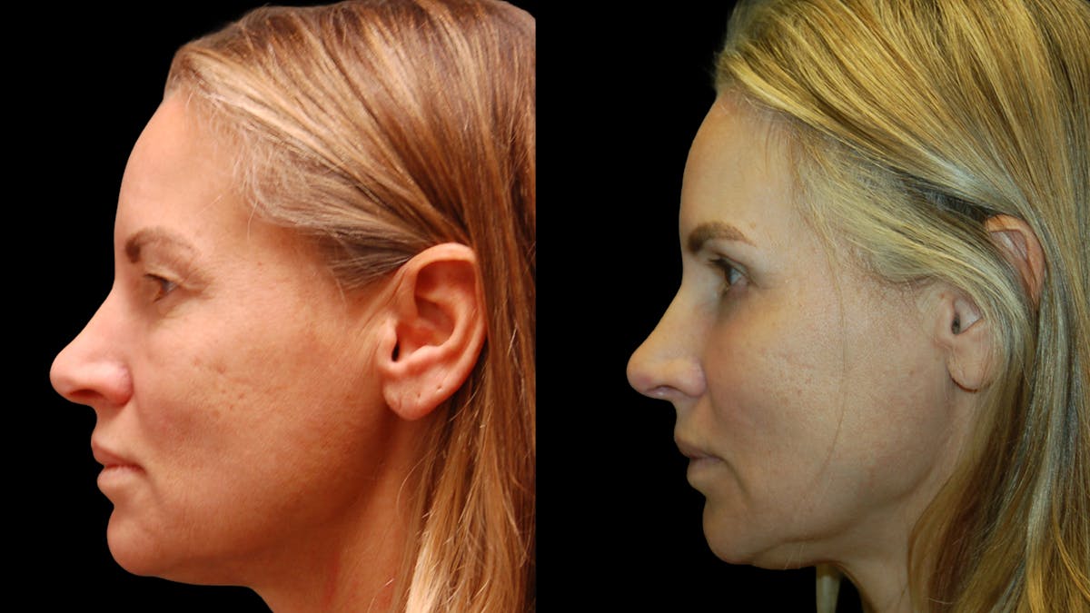 Upper & Lower Eyelid Surgery Before & After Gallery - Patient 154708 - Image 5