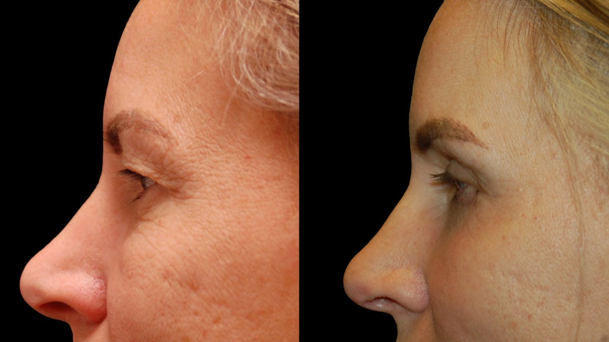 Upper & Lower Eyelid Surgery Before & After Gallery - Patient 154708 - Image 6