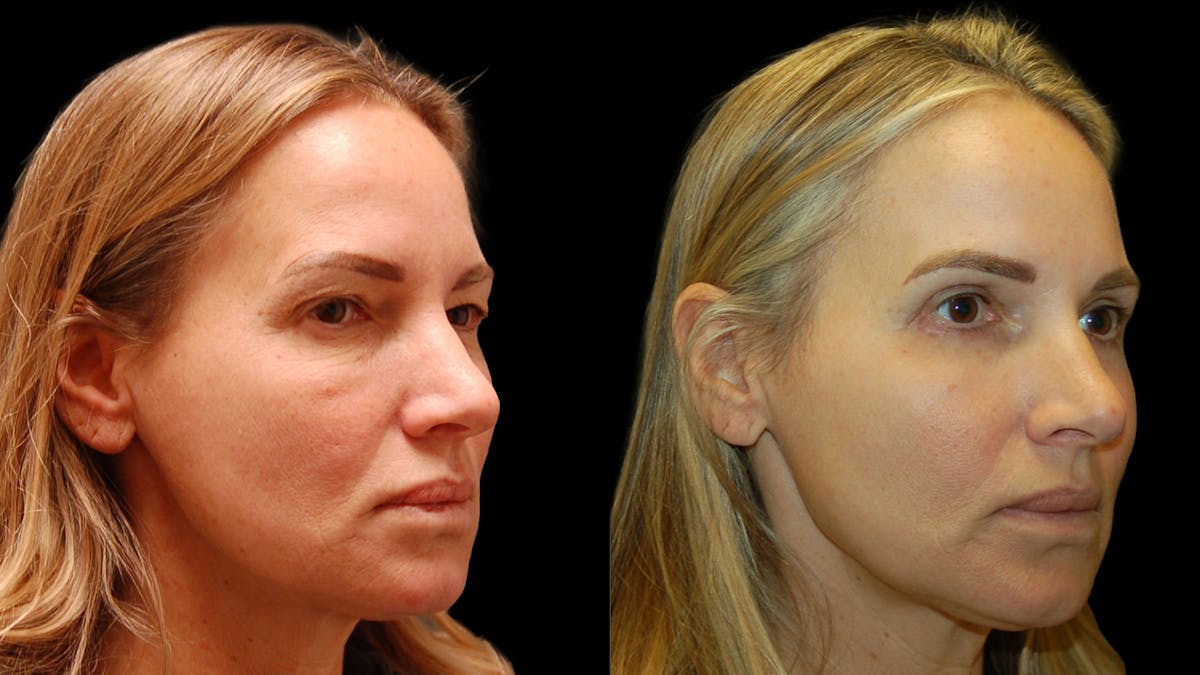 Upper & Lower Eyelid Surgery Before & After Gallery - Patient 154708 - Image 7