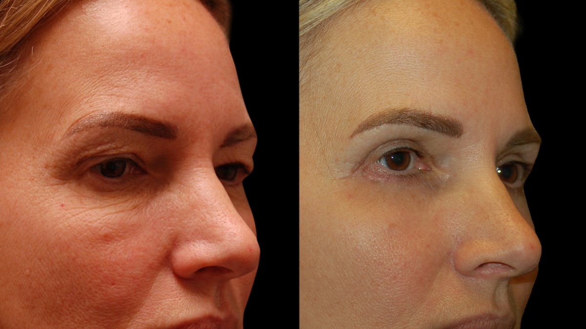 Upper & Lower Eyelid Surgery Before & After Gallery - Patient 154708 - Image 8