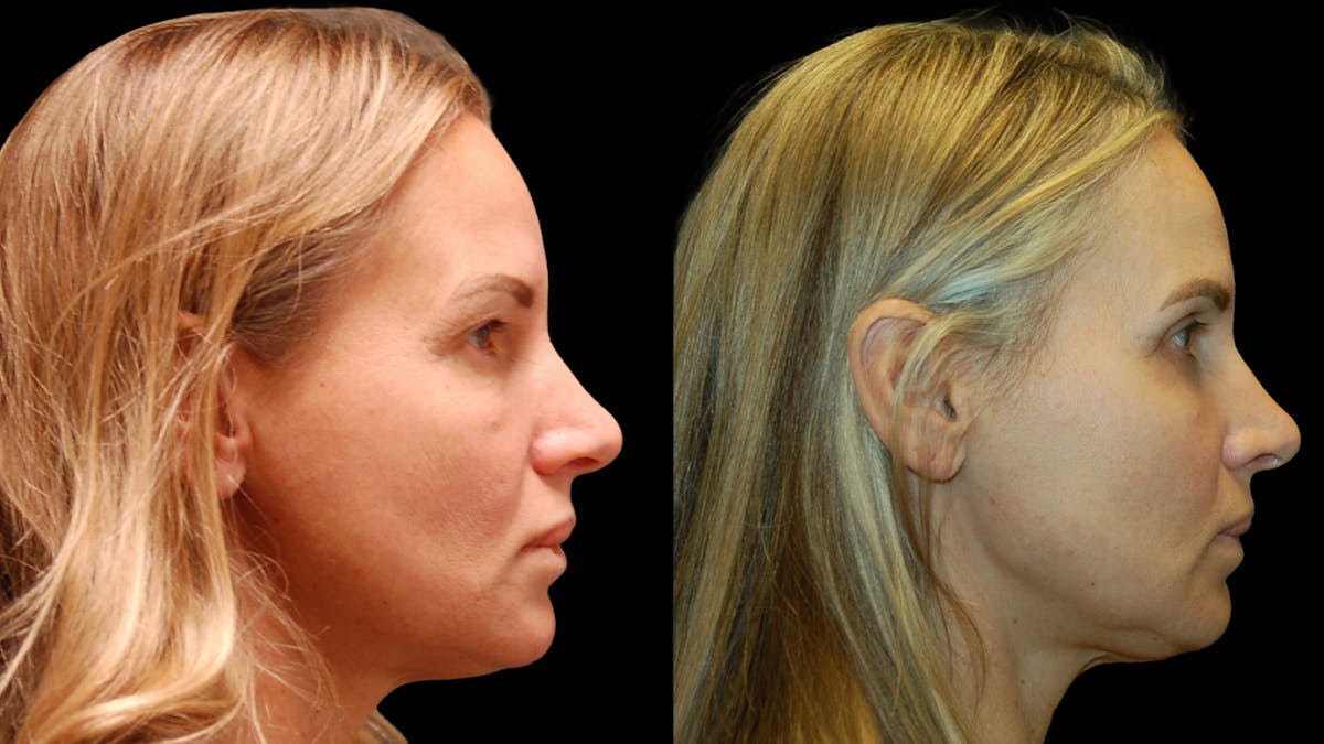 Upper & Lower Eyelid Surgery Before & After Gallery - Patient 154708 - Image 9