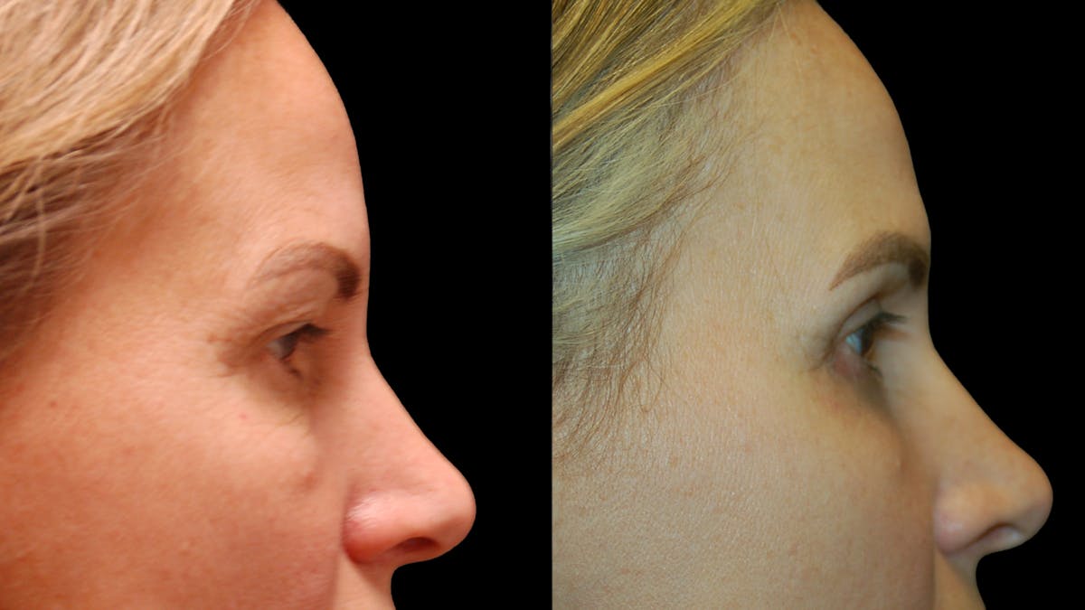 Upper & Lower Eyelid Surgery Before & After Gallery - Patient 154708 - Image 10
