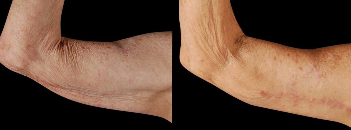 Arm Lift Before & After Gallery - Patient 919577 - Image 1