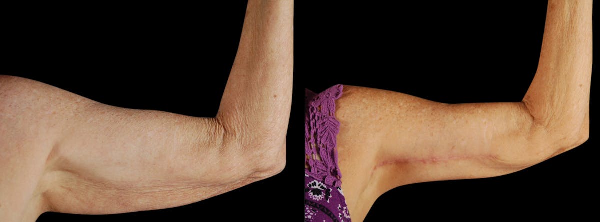 Arm Lift Before & After Gallery - Patient 919577 - Image 2