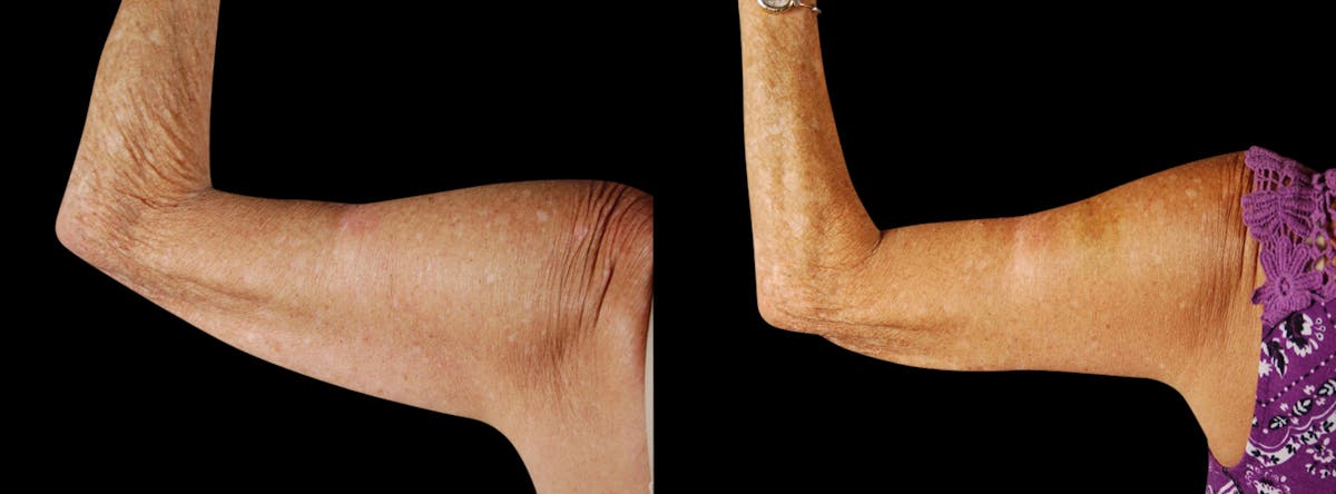Arm Lift Before & After Gallery - Patient 919577 - Image 3